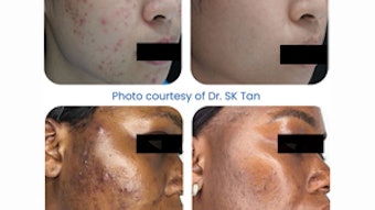 Leading device-based efficacy: acne clearance with Aerolase Neo Elite